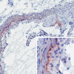 MBL-A in atherosclerotic lesions