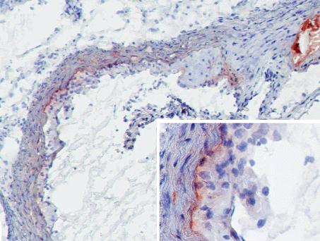 MBL-A in atherosclerotic lesions