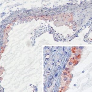 MBL-C in atherosclerotic lesions