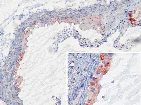 MBL-C in atherosclerotic lesions