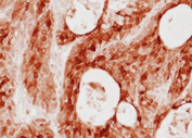 IHC-P: BxPC3 tumor section